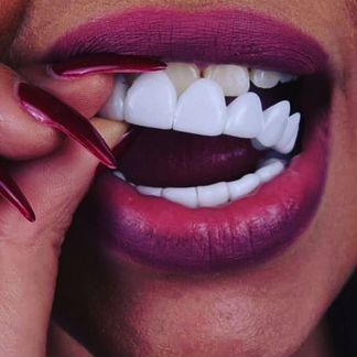 Виниры Snap-On Smile